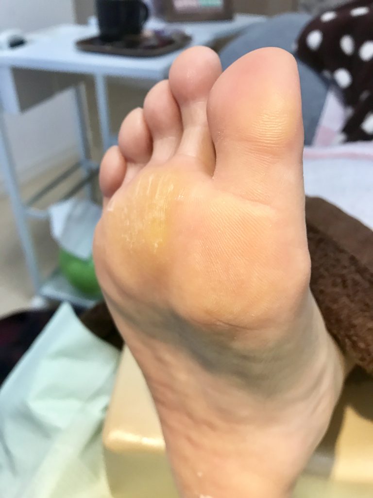 足の乾燥と指の付け根のタコ ウオノメ ブログ 公式サイト フットケアサロンlavie 熊本市南区フットケア専門店