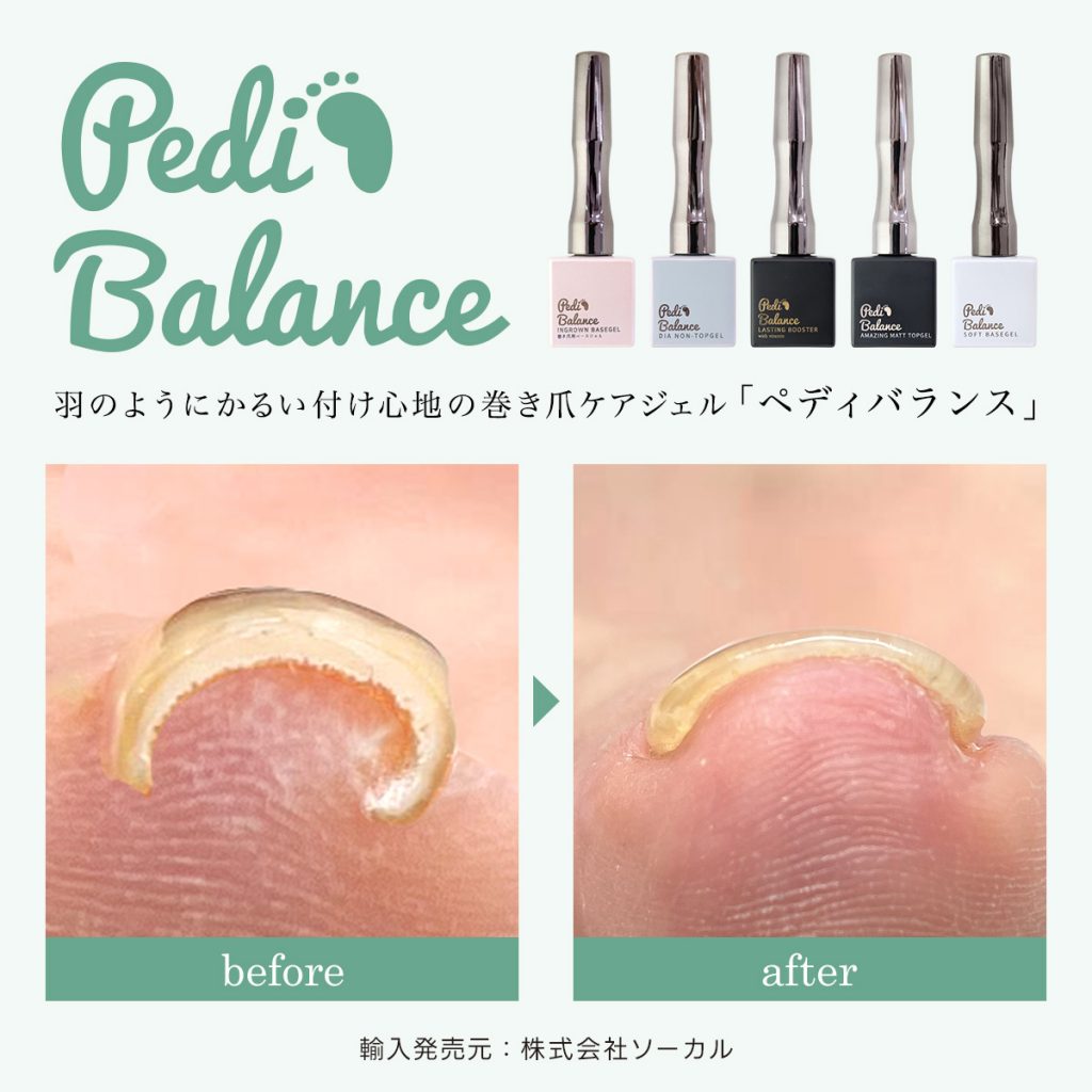 熊本初導入✨カラーもOKの巻き爪ケアペディバランス | ブログ